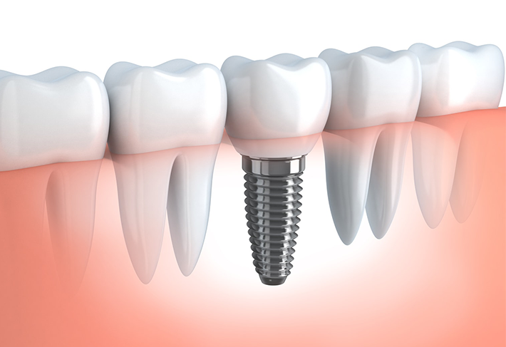 インプラント・入れ歯