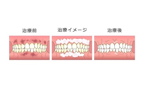 ガムピーリング