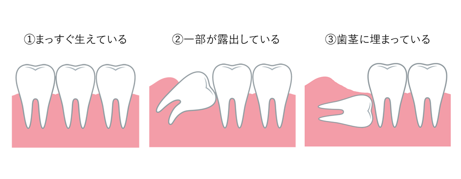 入れ歯（義歯）について